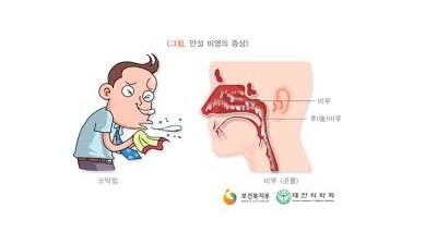 비염약 부작용 소화불량과 체기