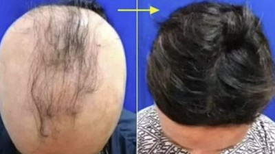 “탈모 환자 머리카락 80% 다시 자랐다”…美서 신약 개발