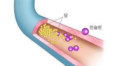 당뇨병 시작 신호, 초기에 잡아낼 수 있다